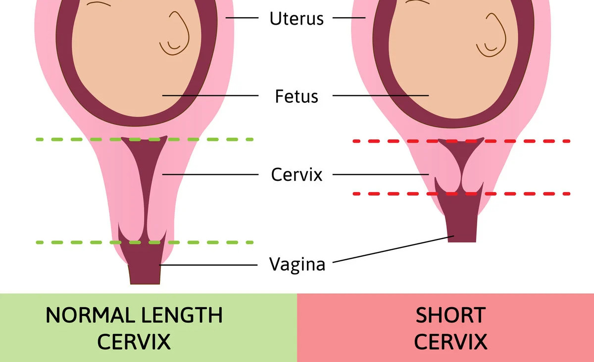 normal-short-cervical-length.jpg