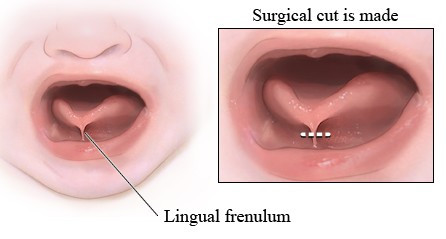 tongue-tie-operation.jpg