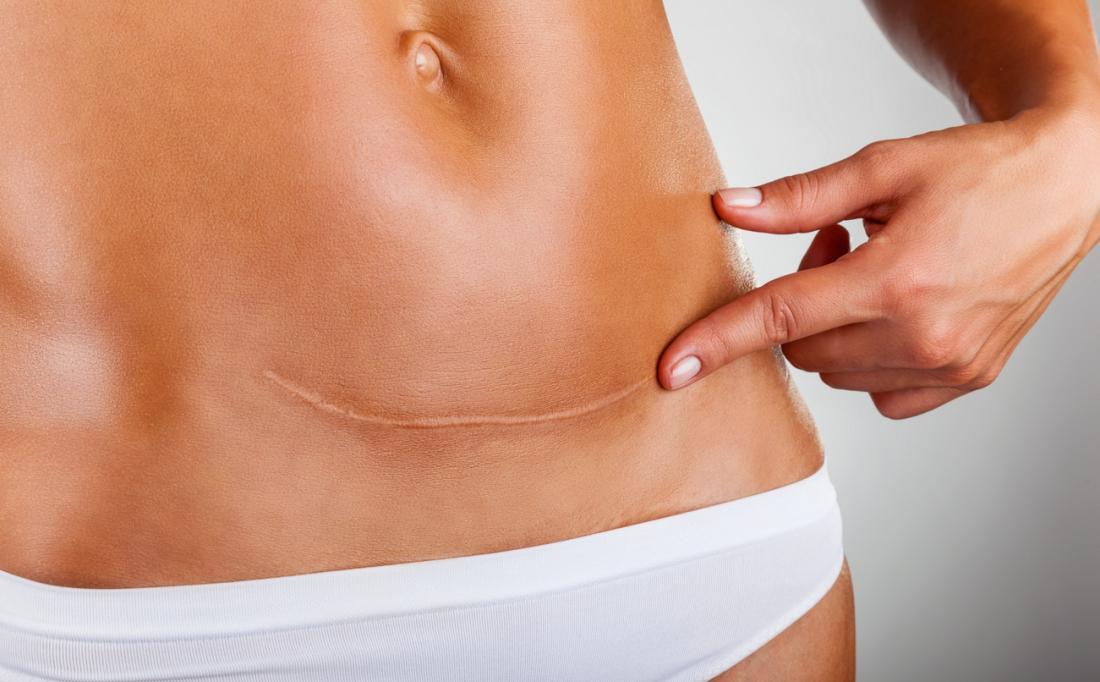 woman-with-c-section-scar.jpg