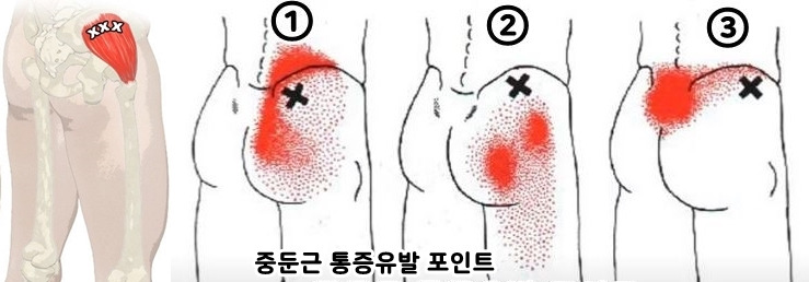 중둔근_통증유발_포인트.jpg