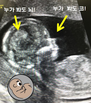 임신 10주- 태아초음파.jpg