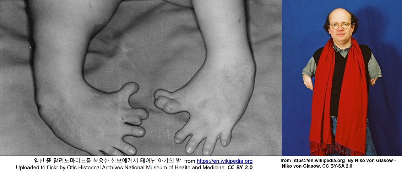 탈리도마이드 발.jpg