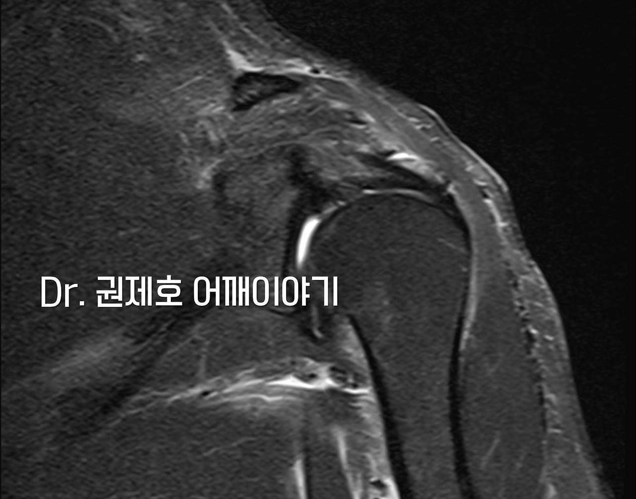 어깨석회성건염 (4).jpg