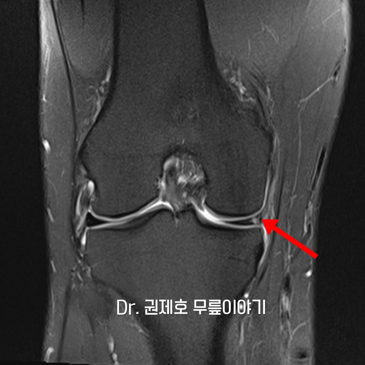 무릎연골판 방사형파열 (15).jpg
