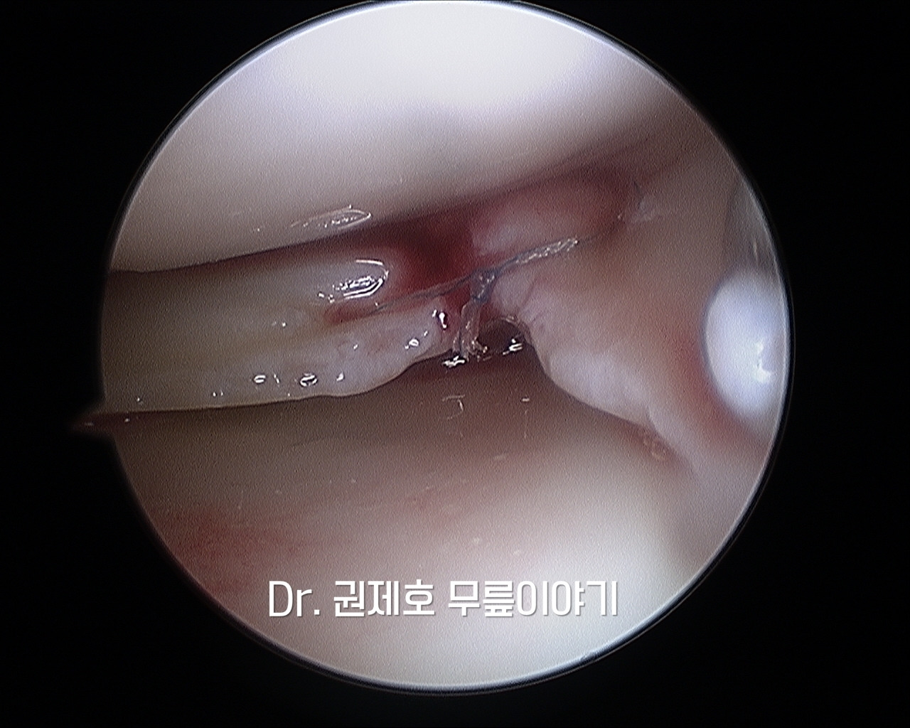 무릎연골판 방사형파열 (4).jpg