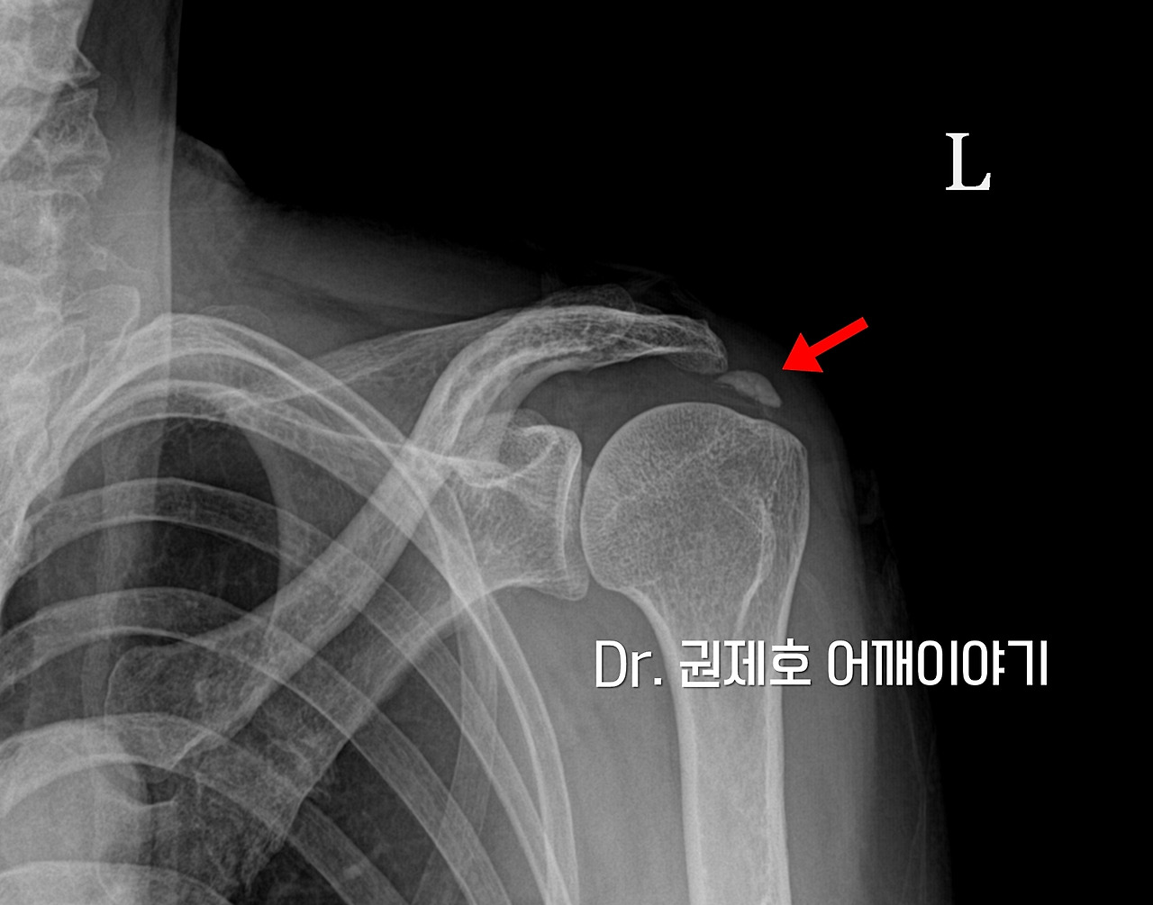어깨석회성건염 (13).jpg