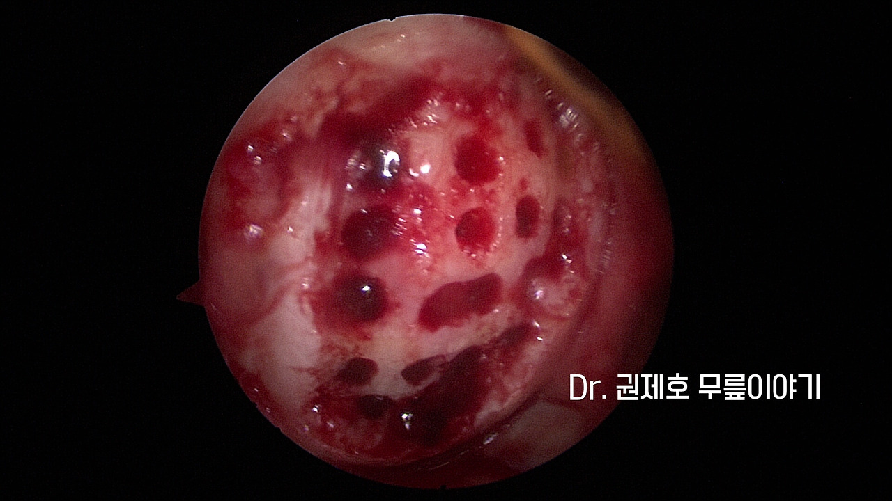 무릎연골줄기세포치료 (5).jpg
