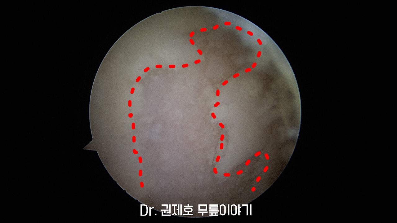 무릎연골줄기세포치료 (11).jpg