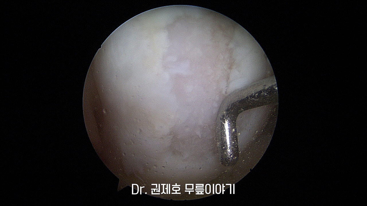 무릎연골줄기세포치료 (10).jpg