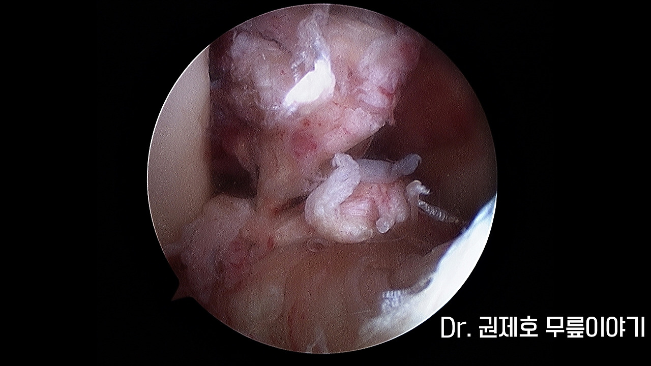 전방십자인대파열 타가건 재건술 (16).jpg