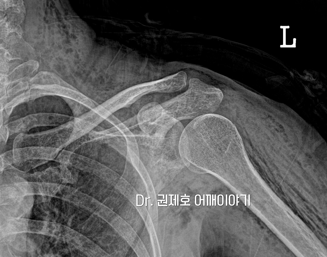 어깨석회성건염 (12).jpg