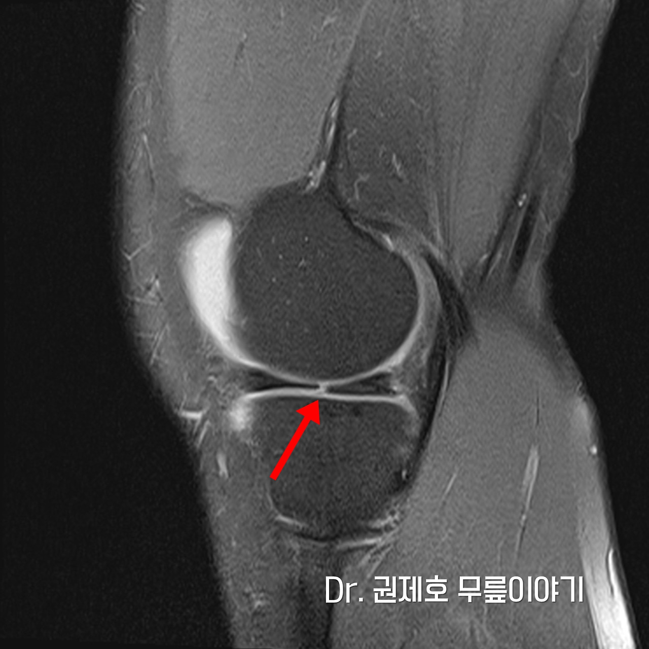 무릎연골판 방사형파열 (13).jpg