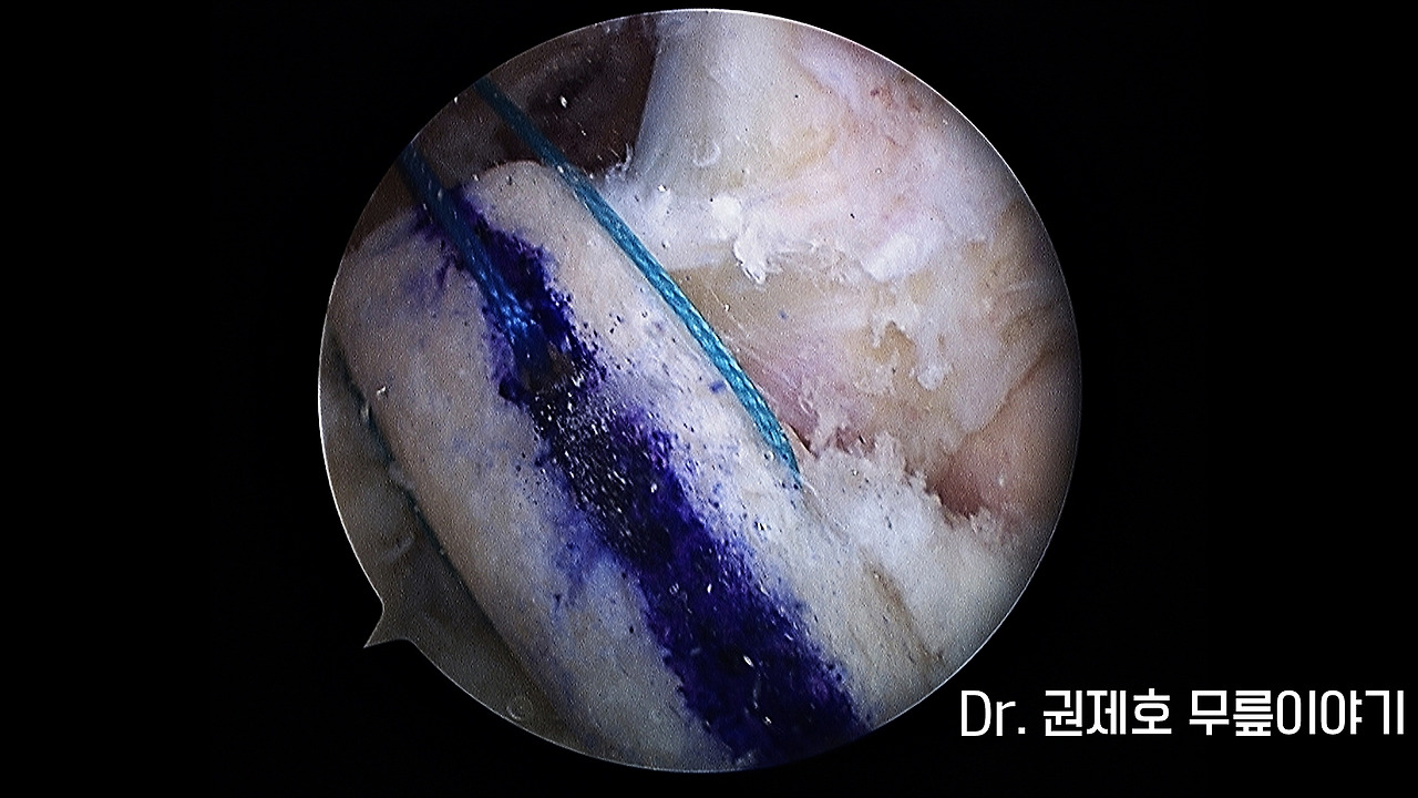 전방십자인대파열 타가건 재건술 (8).jpg