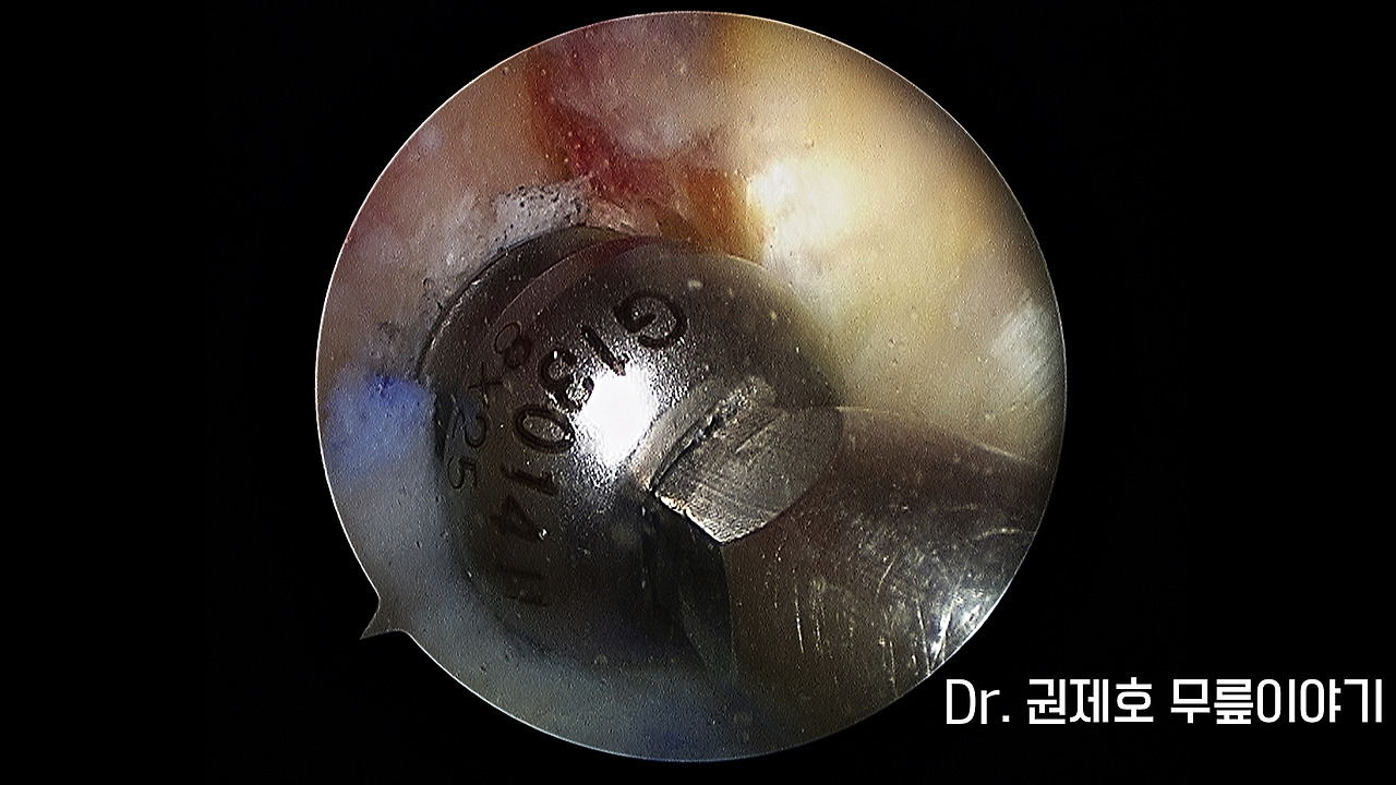 전방십자인대파열 타가건 재건술 (7).jpg