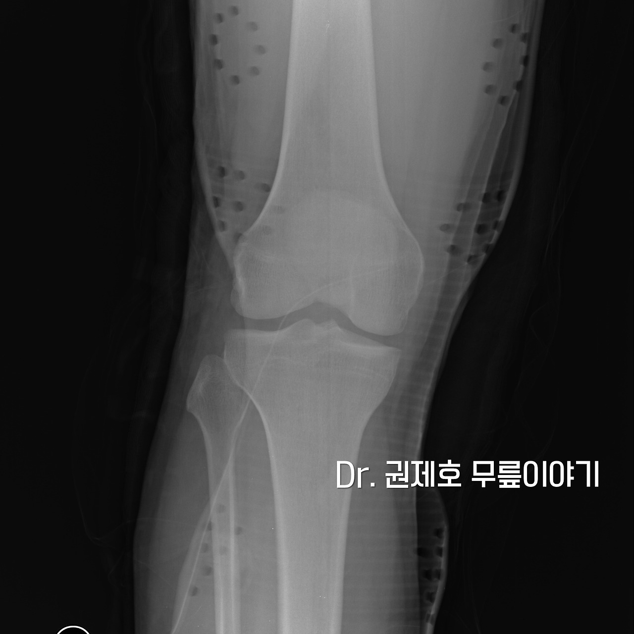 무릎연골판 방사형파열 (2).jpg