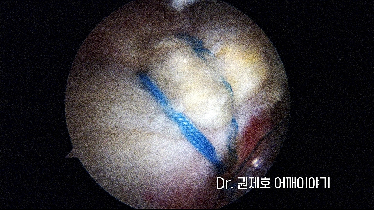 회전근개파열 5.jpg