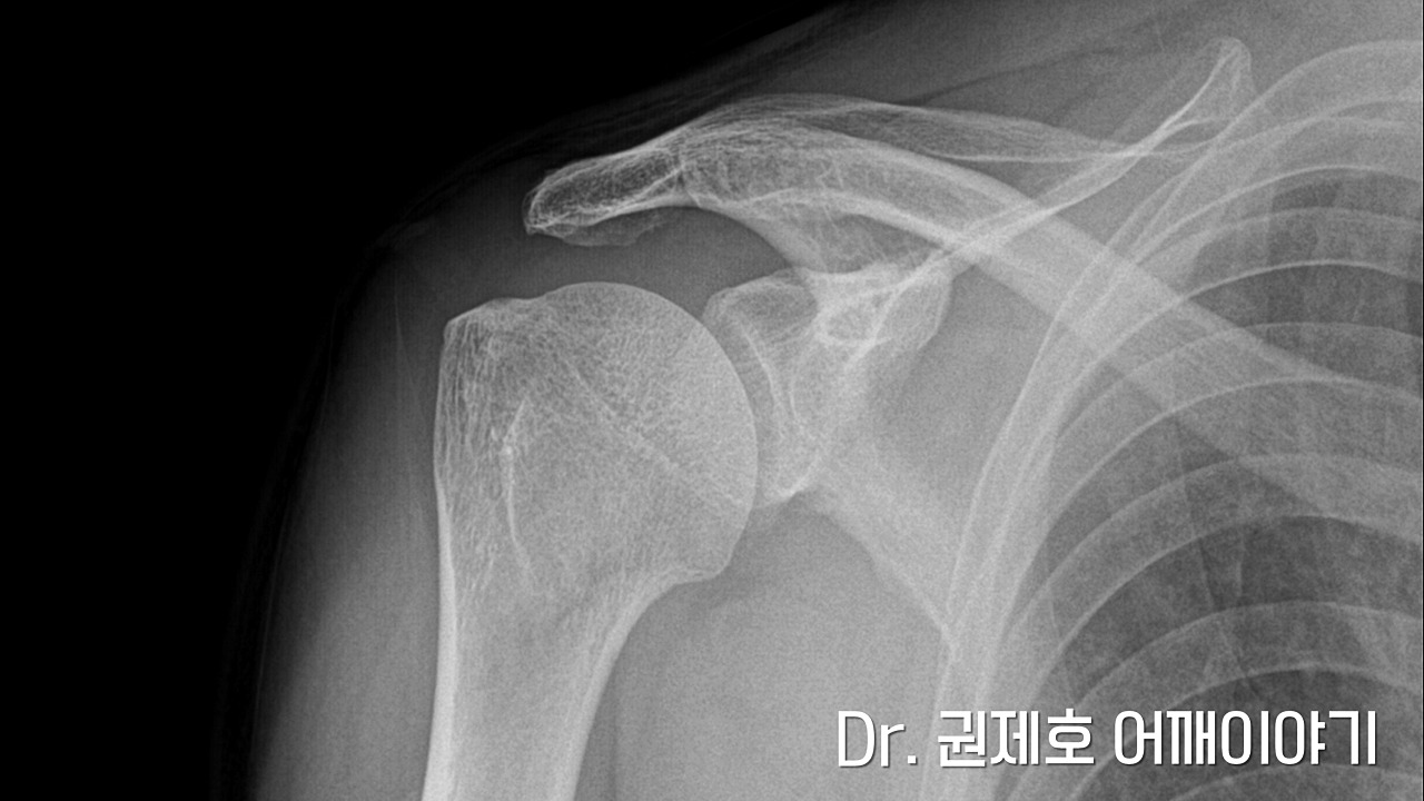 회전근개파열 1.jpg