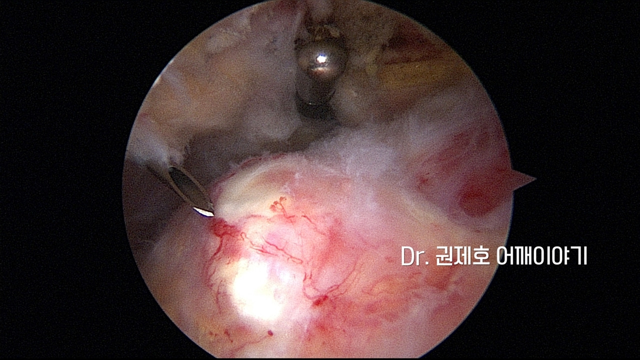 어깨석회성건염 (8).jpg