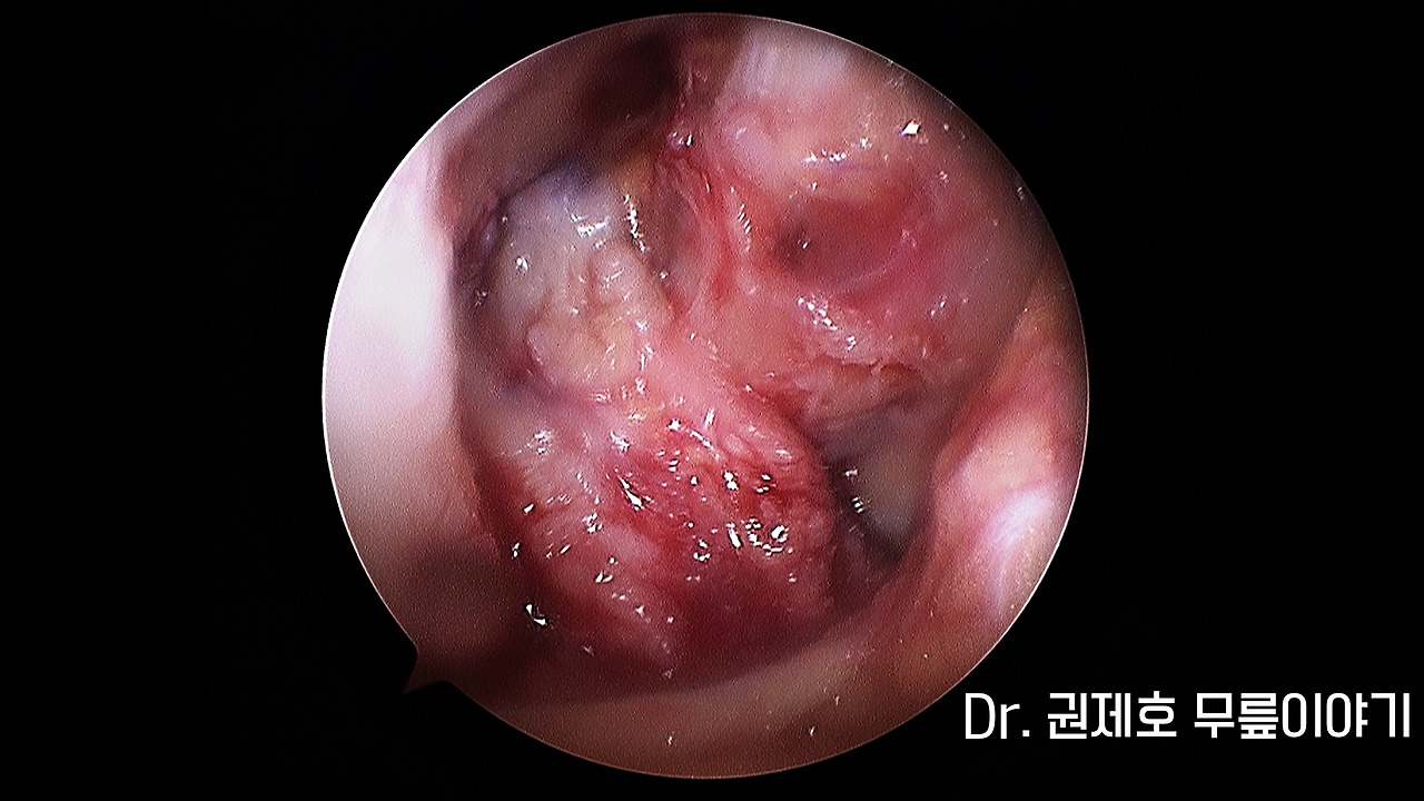 전방십자인대파열 타가건 재건술 (6).jpg