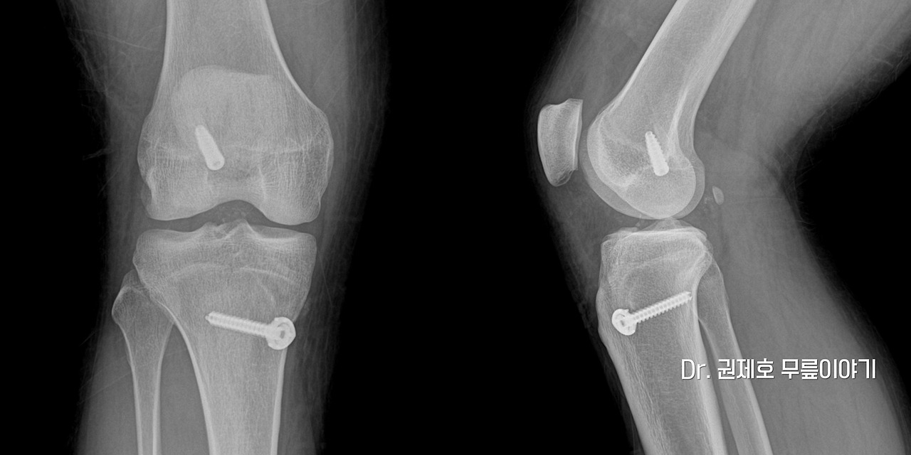 전방십자인대파열 타가건 재건술 (3).jpg
