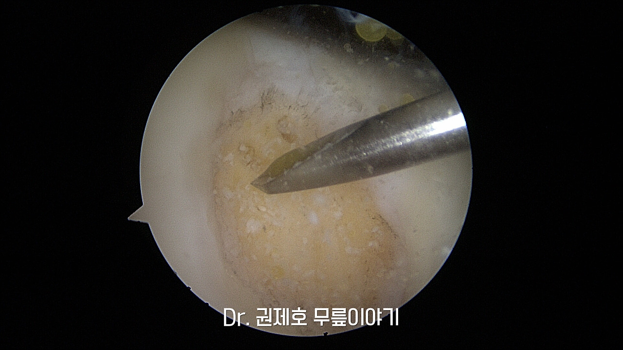 무릎연골줄기세포치료 (8).jpg