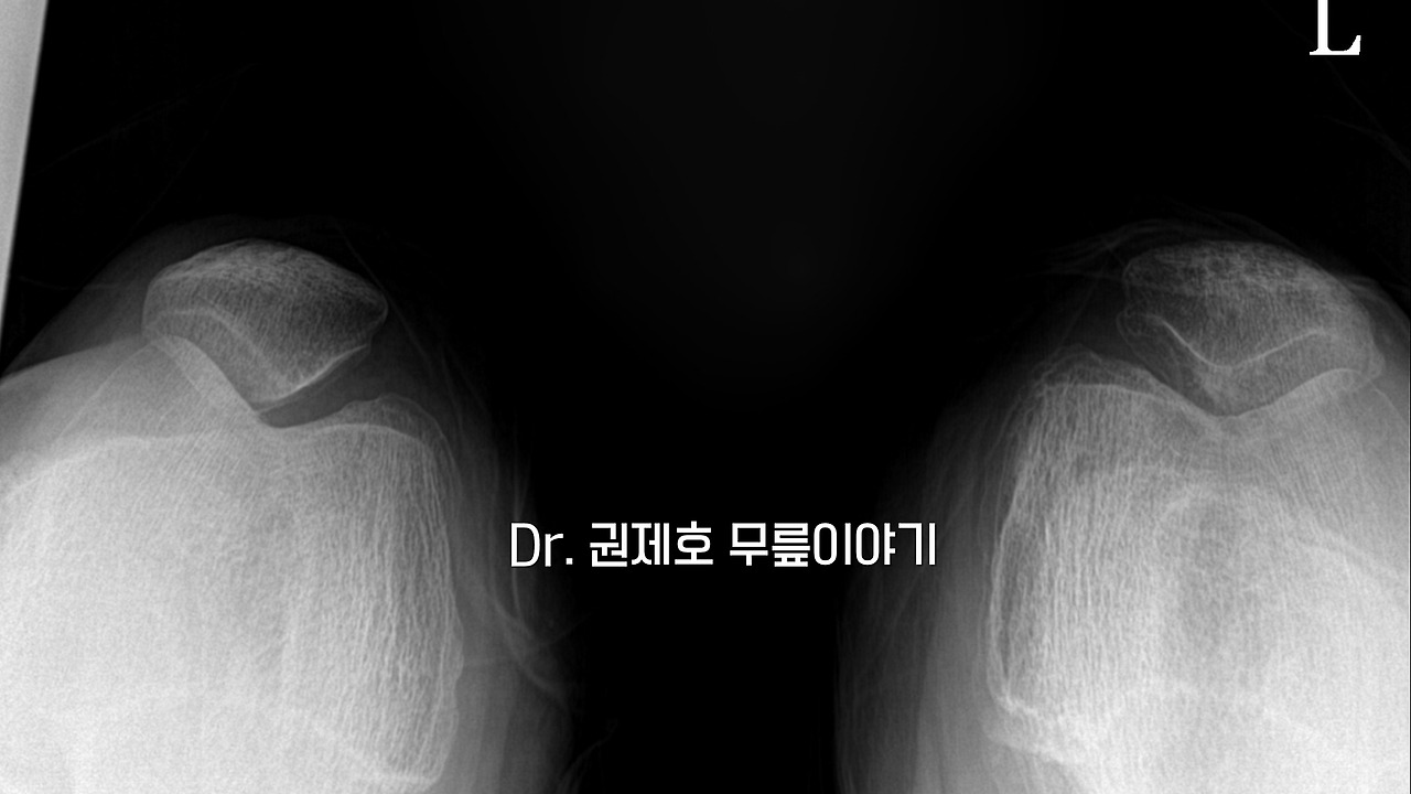 퇴행성관절염 인공관절 수술 과정 (7).jpg