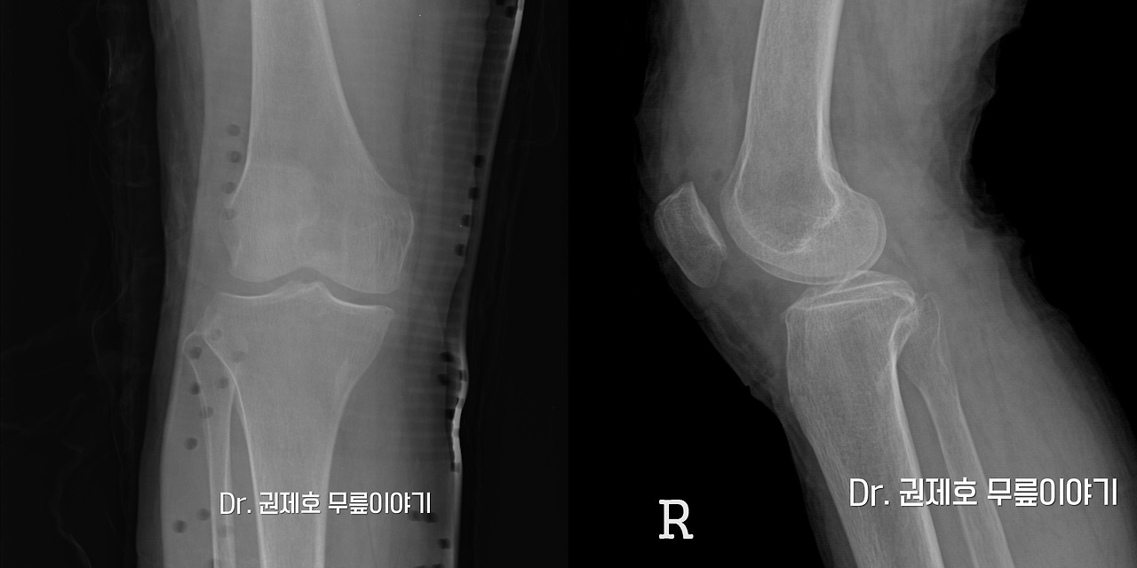 무릎연골줄기세포치료 (2)-horz.jpg