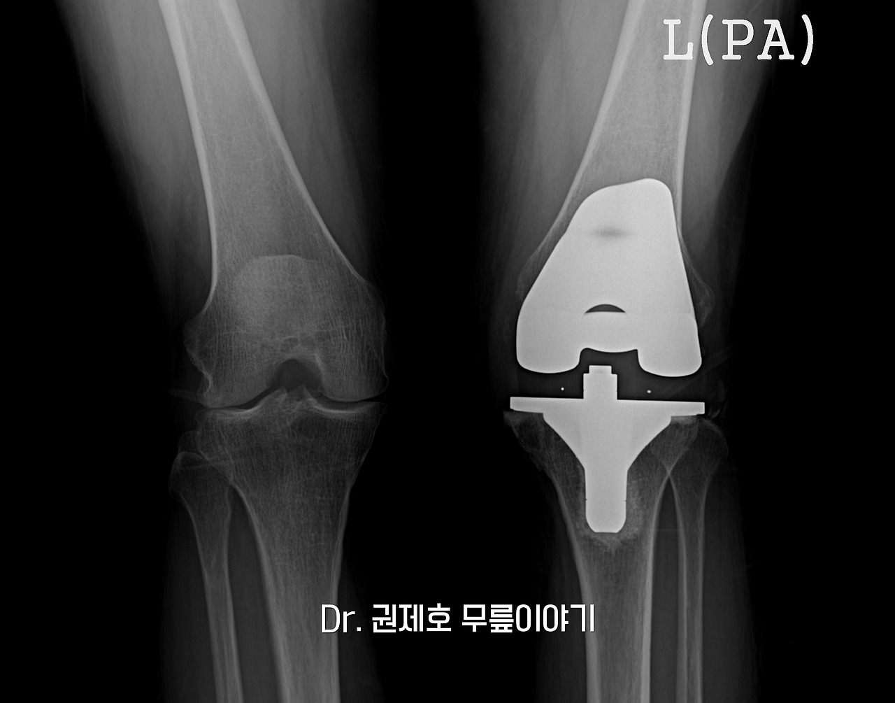 퇴행성관절염 인공관절 수술 과정 (9).jpg