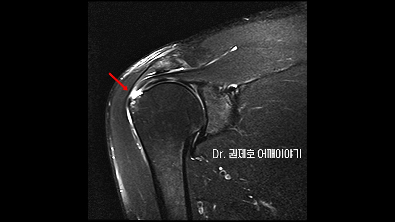 회전근개파열 1.jpg