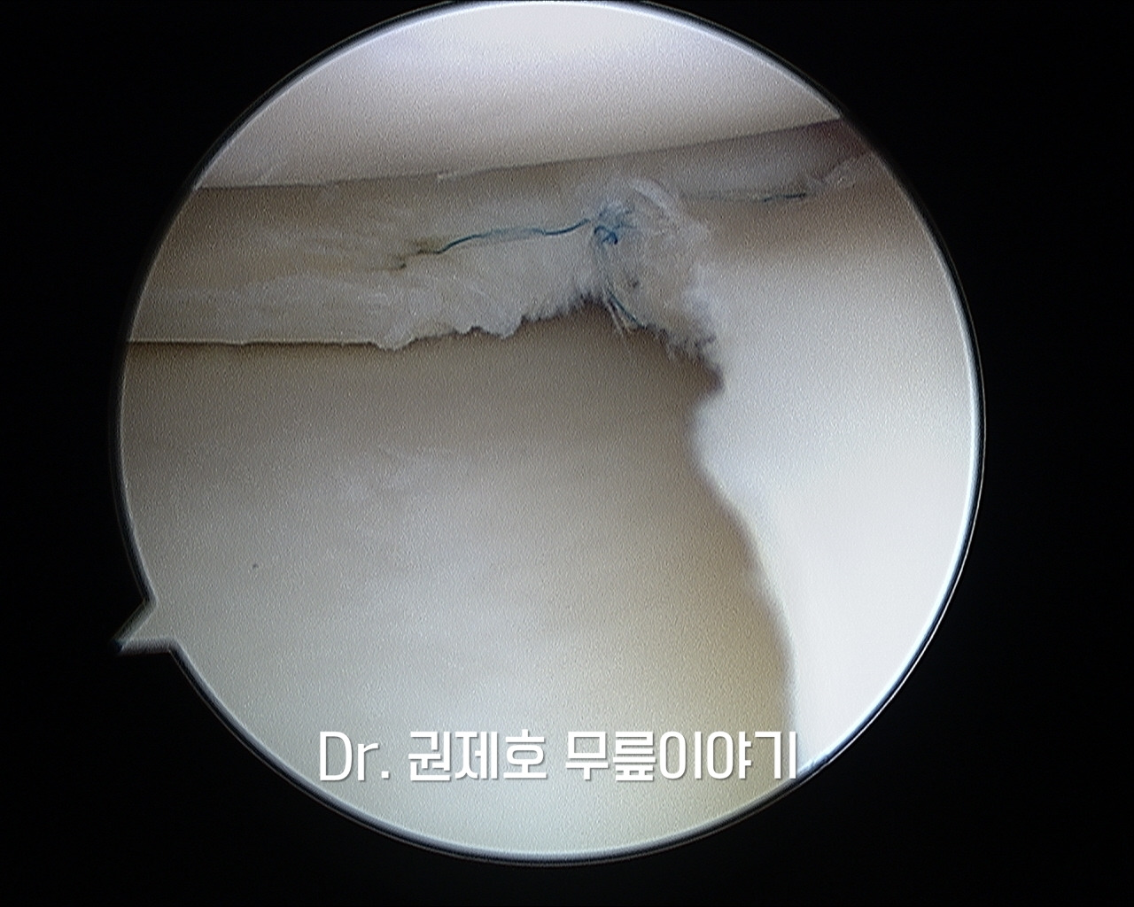 무릎연골판 방사형파열 (5).jpg