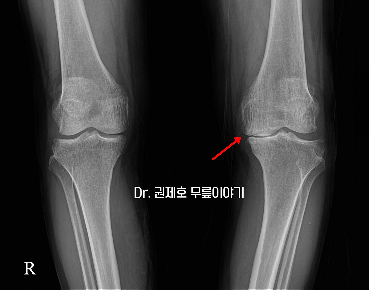 퇴행성관절염 인공관절 수술 과정 (3).jpg