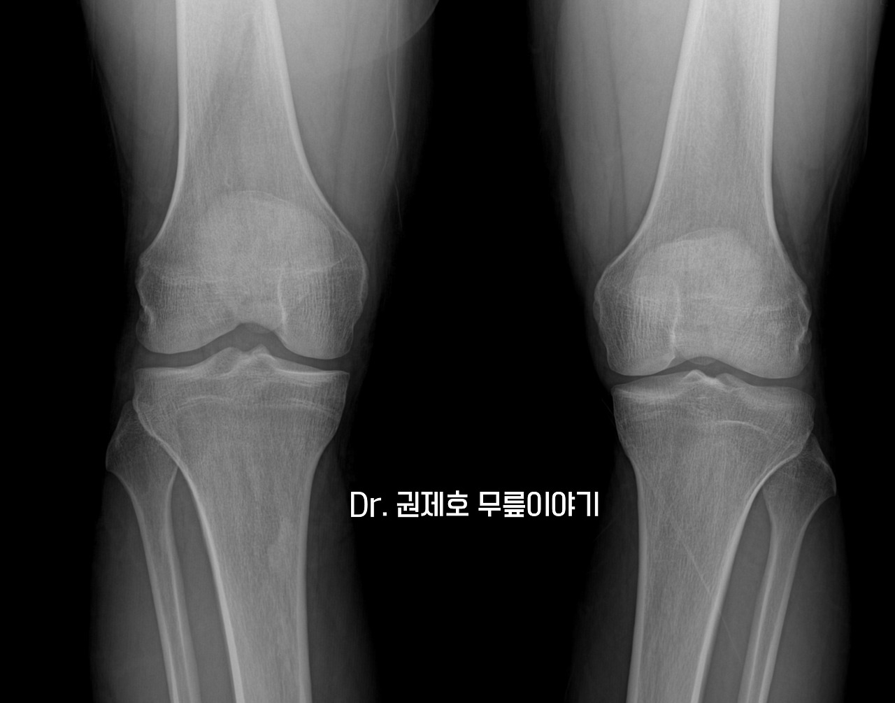 무릎연골판 방사형파열 (12).jpg