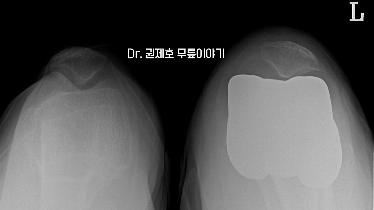 퇴행성관절염 인공관절 수술 과정 (10).jpg