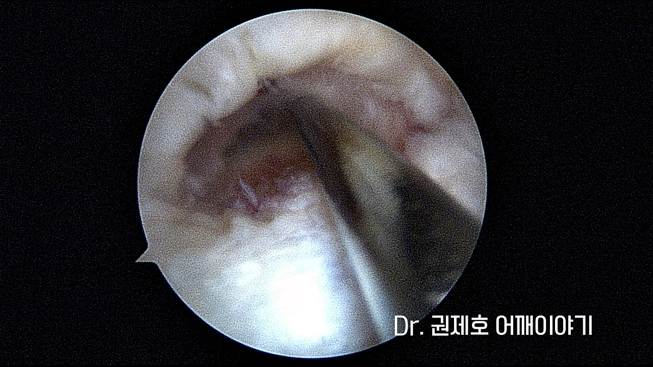 회전근개파열 3.jpg