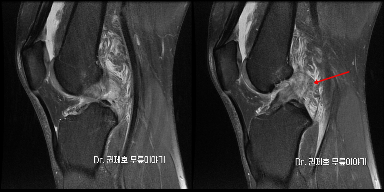 전방십자인대파열 타가건 재건술 (2).jpg