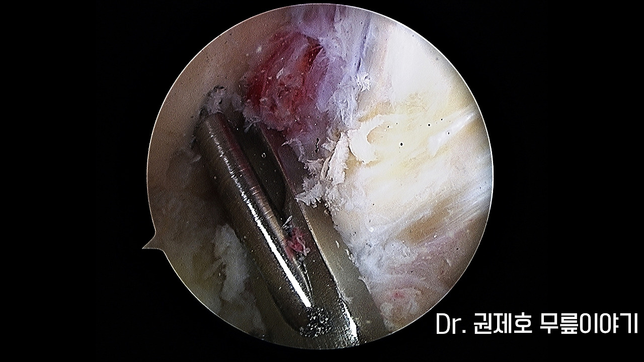 전방십자인대파열 타가건 재건술 (11).jpg