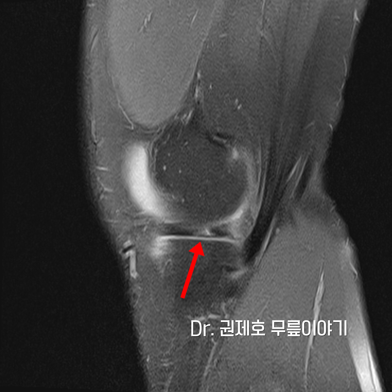 무릎연골판 방사형파열 (14).jpg