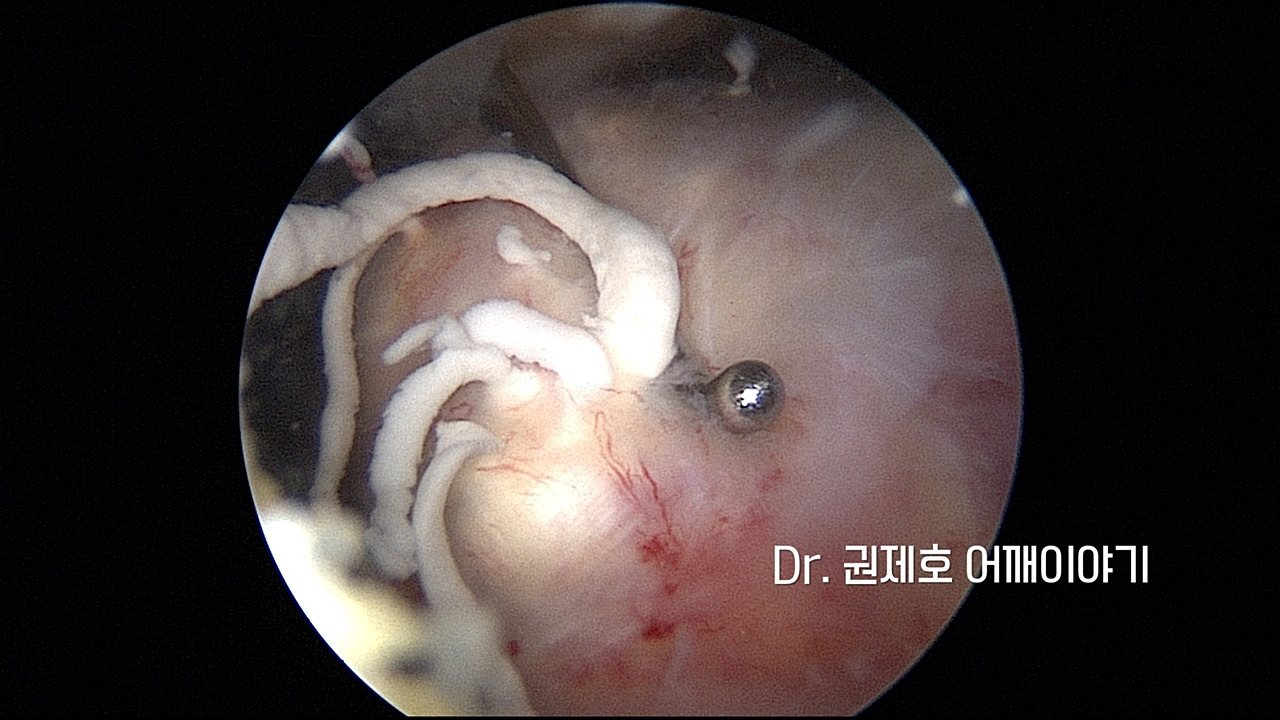 어깨석회성건염 (2).jpg