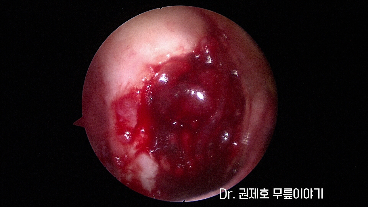 무릎연골줄기세포치료 (4).jpg