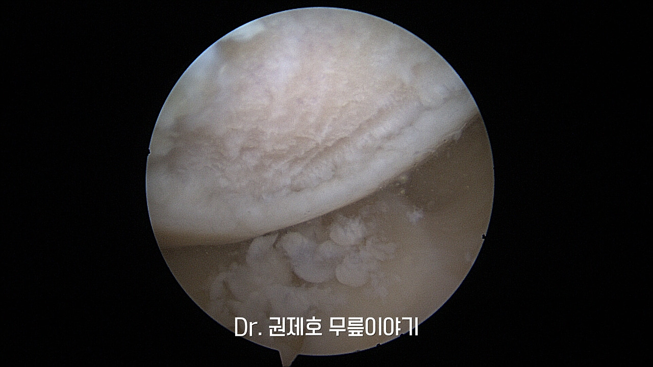 무릎연골줄기세포치료 (9).jpg