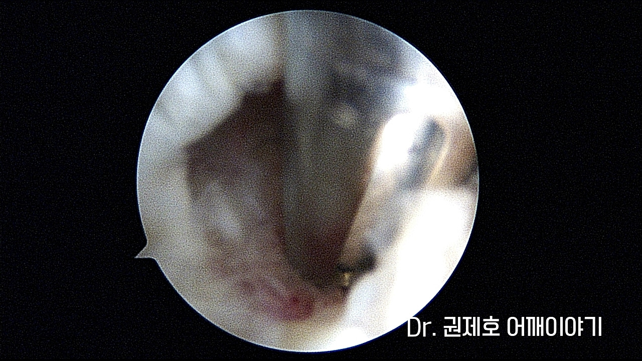 회전근개파열 4.jpg