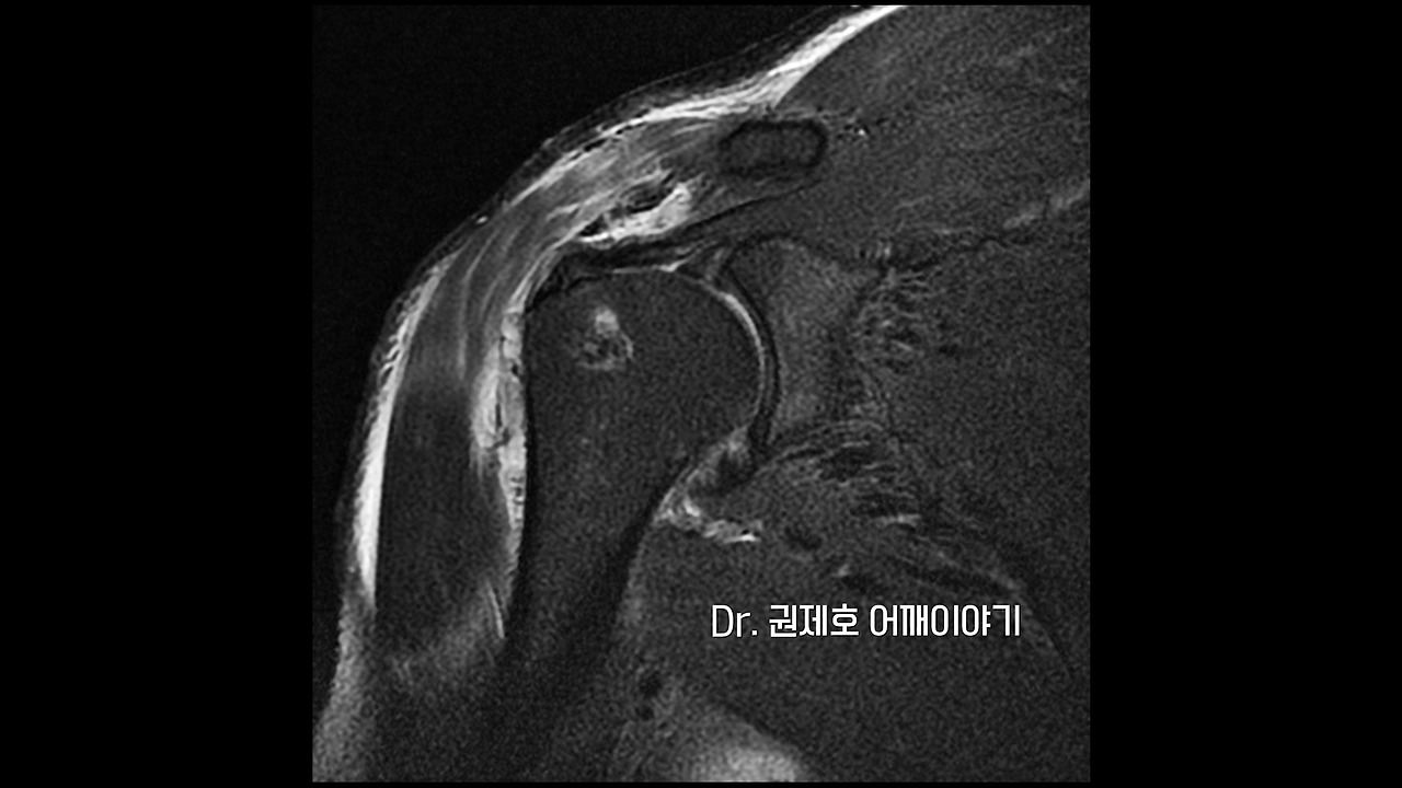 회전근개파열 7.jpg