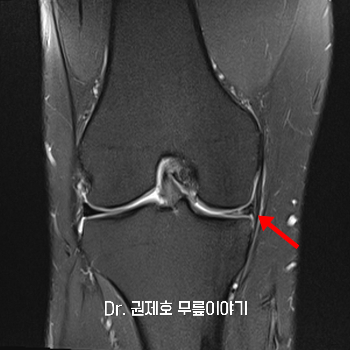 무릎연골판 방사형파열 (16).jpg