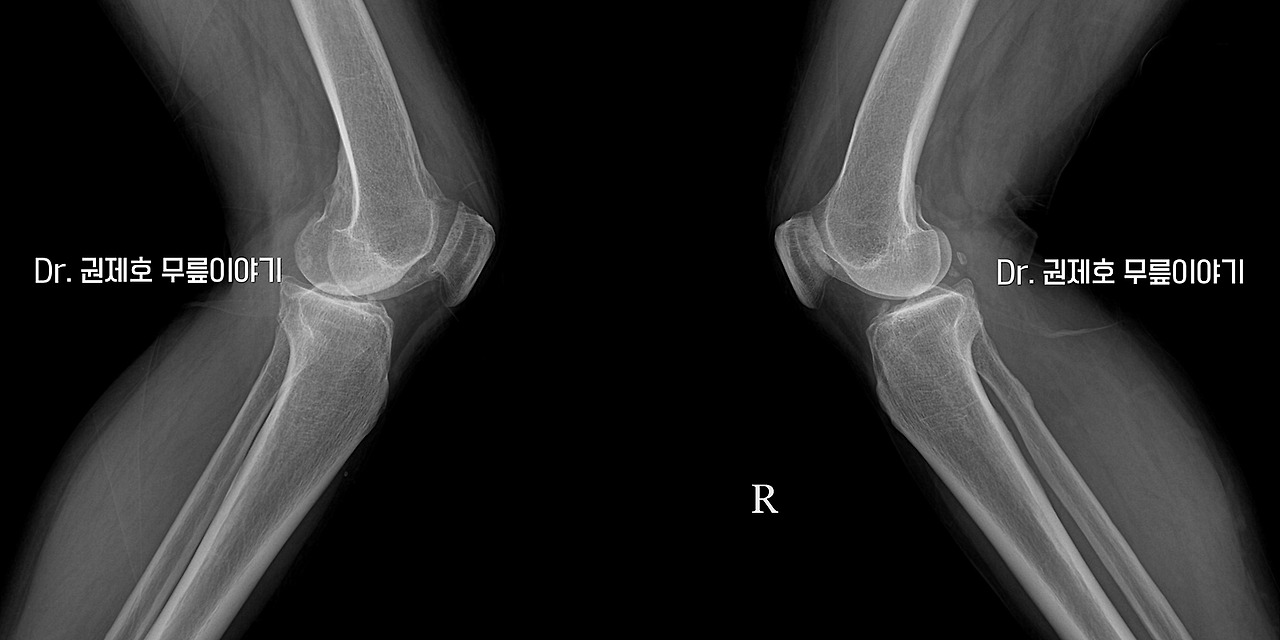 퇴행성관절염 인공관절 수술 과정 (4).jpg