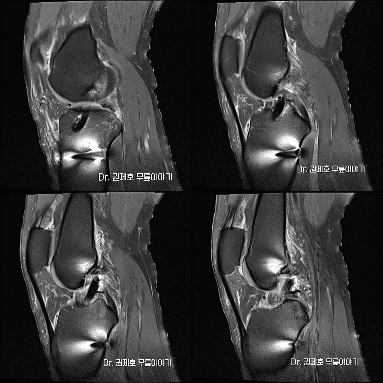 전방십자인대파열 타가건 재건술 (4).jpg