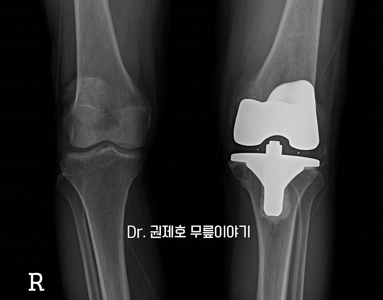 퇴행성관절염 인공관절 수술 과정 (8).jpg