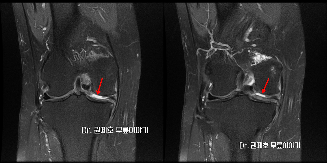 무릎연골줄기세포치료 (16)-horz.jpg