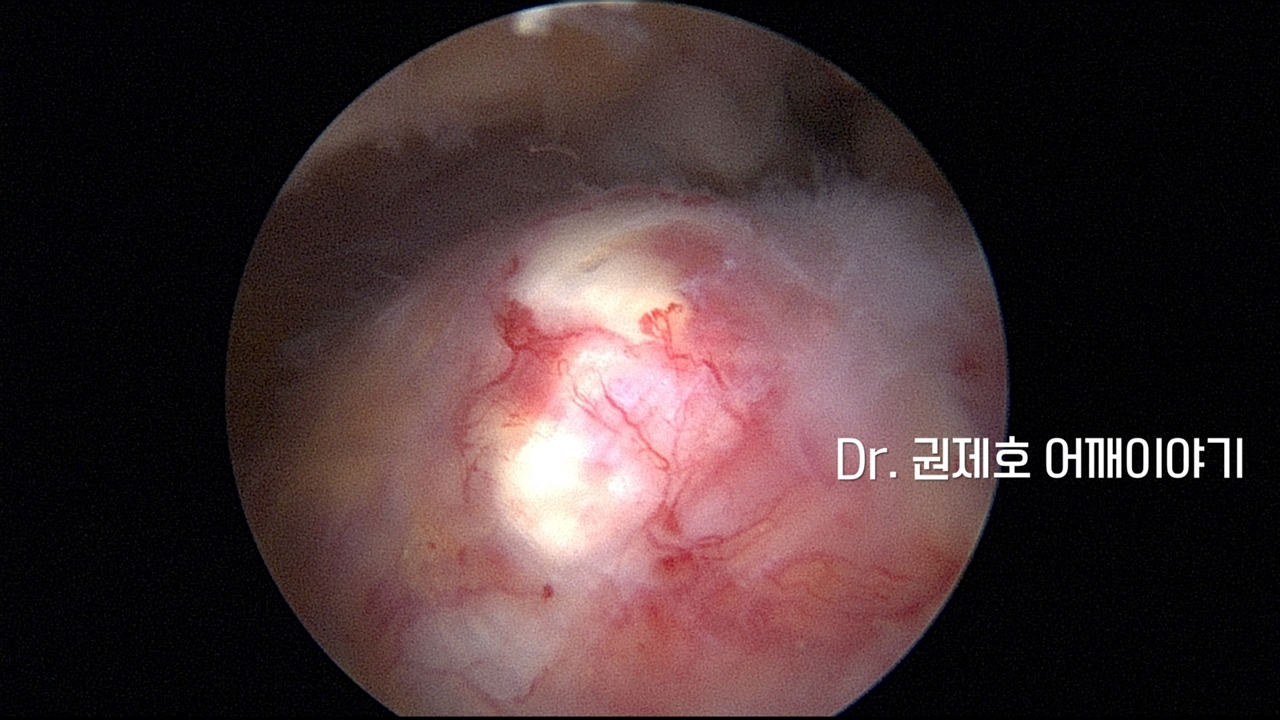 어깨석회성건염 (7).jpg