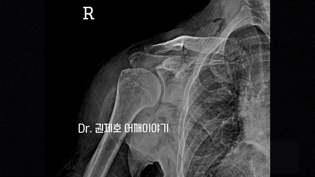 회전근개파열 6.jpg