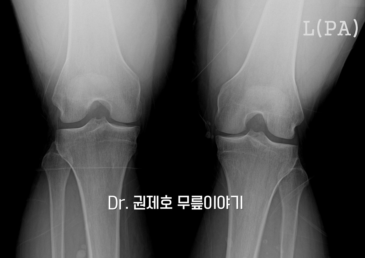 전방십자인대파열 타가건 재건술 (14).jpg